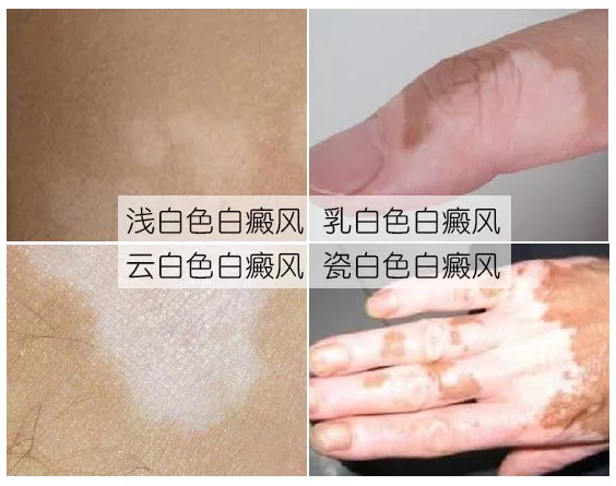 宁波白癜风早期的症状表现都有哪些呢